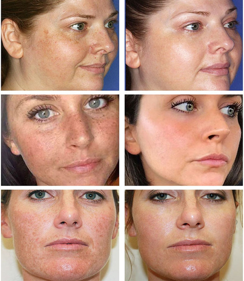 Whitening Freckles, Melasma, Dark Spot, Anti-aging Face Care